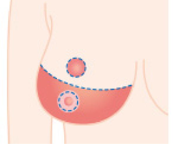 特別法 バストの下半分の余った皮膚と脂肪を取り除きます（イラスト）