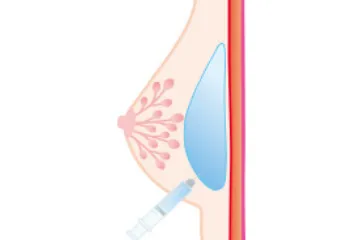 ヒアルロン酸注入豊胸法イメージ図