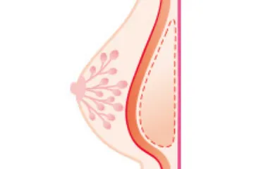 脂肪注入による豊胸術イメージ図