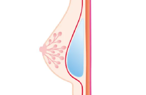 シリコンバッグ筋膜下（イラスト）