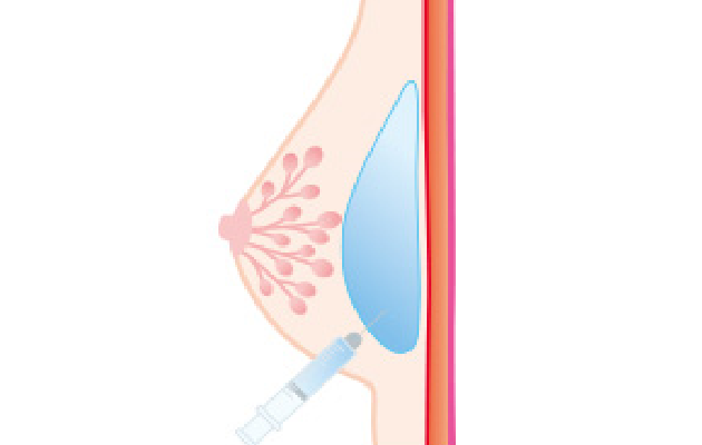 ヒアルロン酸注入豊胸法（イラスト）