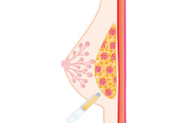 脂肪注入による豊胸術（イラスト）