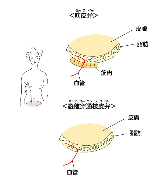 自家組織による乳房再建