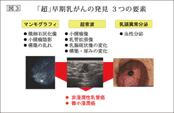 図3：「超」早期乳がんの発見 3つの要素