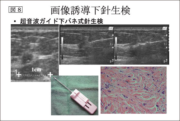 図8：画像誘導下針生検
