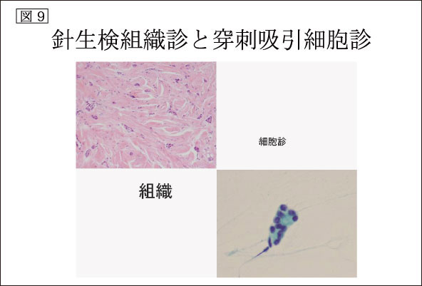 図9：針生検組織診と穿刺吸引細胞診