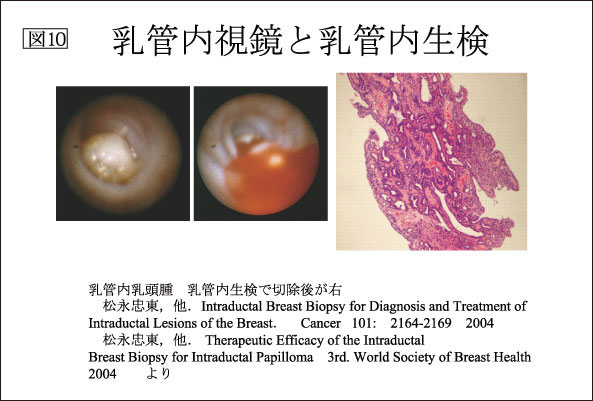 図10：乳管内視鏡と乳管内生検