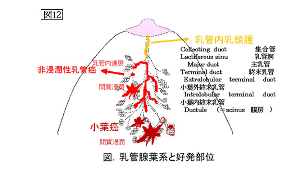 図12：乳管腺葉系と好発部位